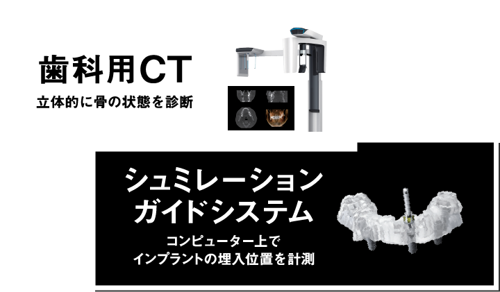 歯科用CT、シュミレーションガイド